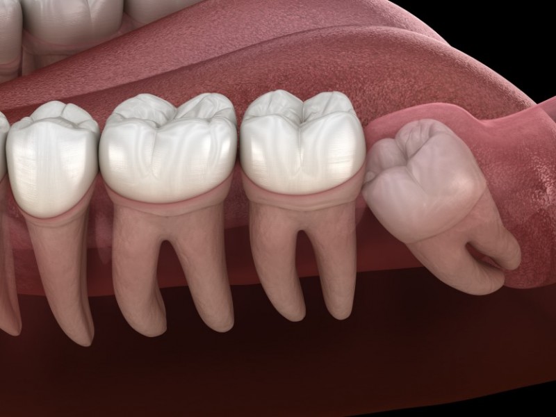 Exposing And Bonding An Impacted Tooth